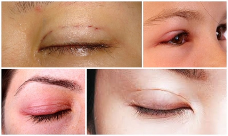 bấm mí bị hỏng