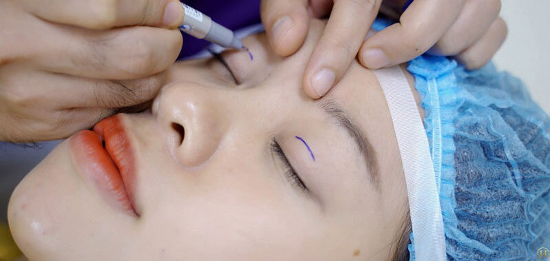 Bấm mí mắt 4 bam mi mat 6 e1758726442682