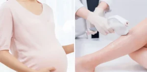 Có bầu triệt lông nách bằng laser