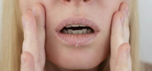 Môi khô nứt, bôi son không ăn