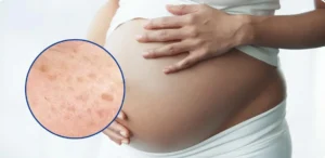 đồi mồi khi mang thai