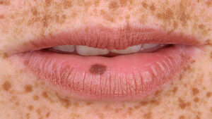 Nám da quanh miệng