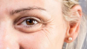 xóa nếp nhăn đuôi mắt