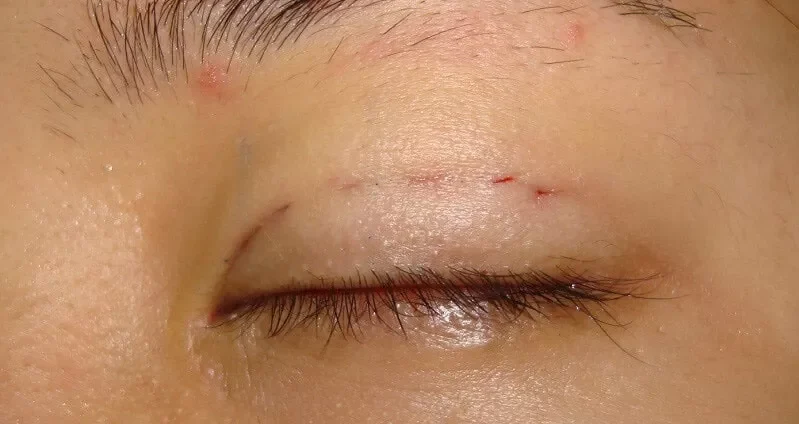 boi thuoc chong seo sau cat mi 6 e1758636632906