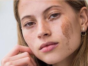 Bớt cà phê sữa