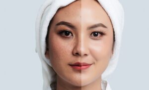 trị nám da mặt lâu năm