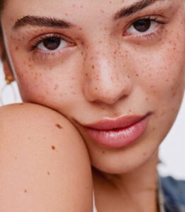 Điều trị tàn nhang