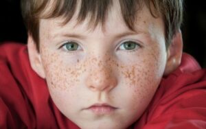 tàn nhang di truyền