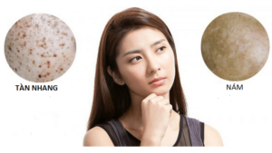 giảm thâm nám và tàn nhang