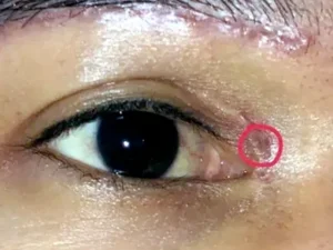 Cắt chỉ mí mắt bị sót có sao không? Cách khắc phục hiệu quả