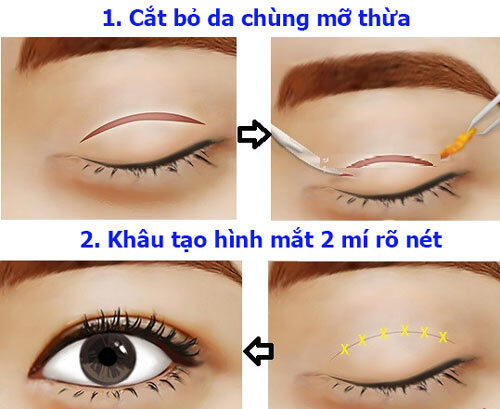 Quá trình cắt mắt 2 mí và những điều cần lưu ý 2 cat mat 2 mi han quoc 1 e1758621383482