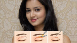 Cắt mí Ấn Độ