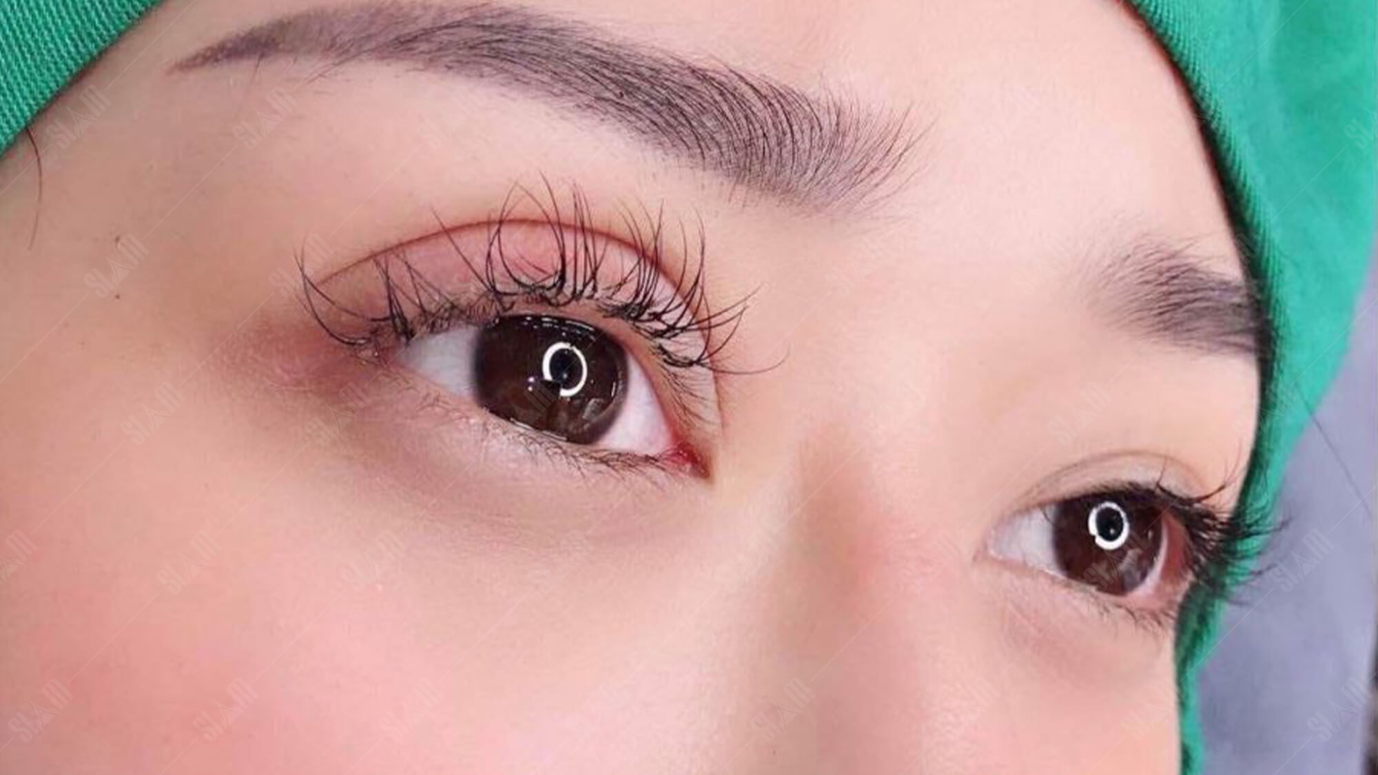Sau phẫu thuật cắt mí mắt có được ăn chuối không? 1 cat mi bao lau thi an duoc thit ga 1
