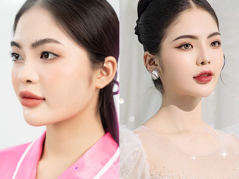 Nguyên nhân cắt mí bị già và cách khắc phục 12 cat mi bi gia 11 e1758633644690