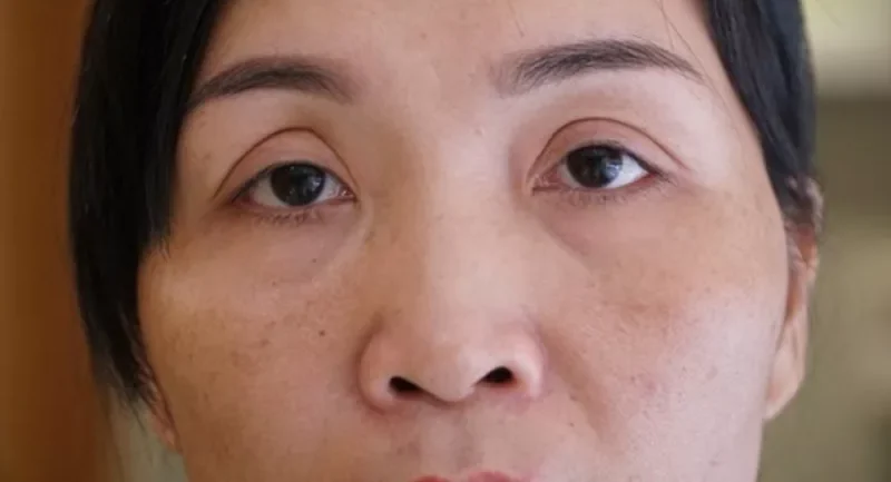 Nguyên nhân cắt mí bị già và cách khắc phục 2 cat mi bi gia 2 e1758633269833