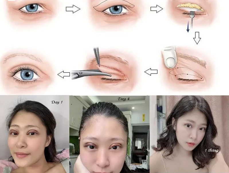 Nguyên nhân cắt mí bị già và cách khắc phục 3 cat mi bi gia 3 e1758633296759
