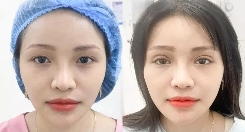 Nguyên nhân cắt mí bị già và cách khắc phục 5 cat mi bi gia 5 e1758633346214