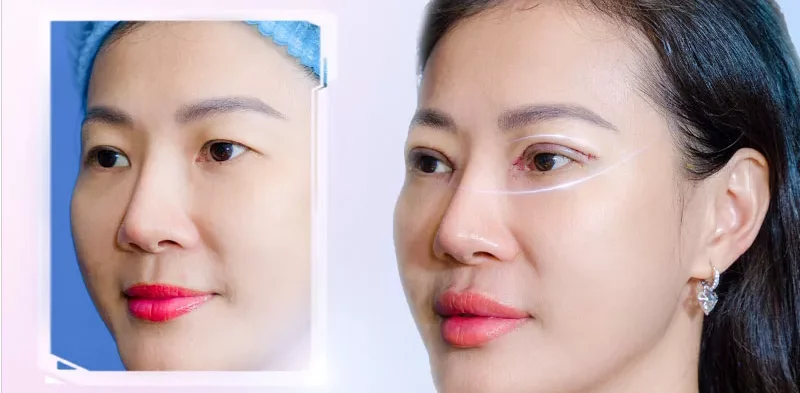 Nguyên nhân cắt mí bị già và cách khắc phục 7 cat mi bi gia 7 e1758633404939