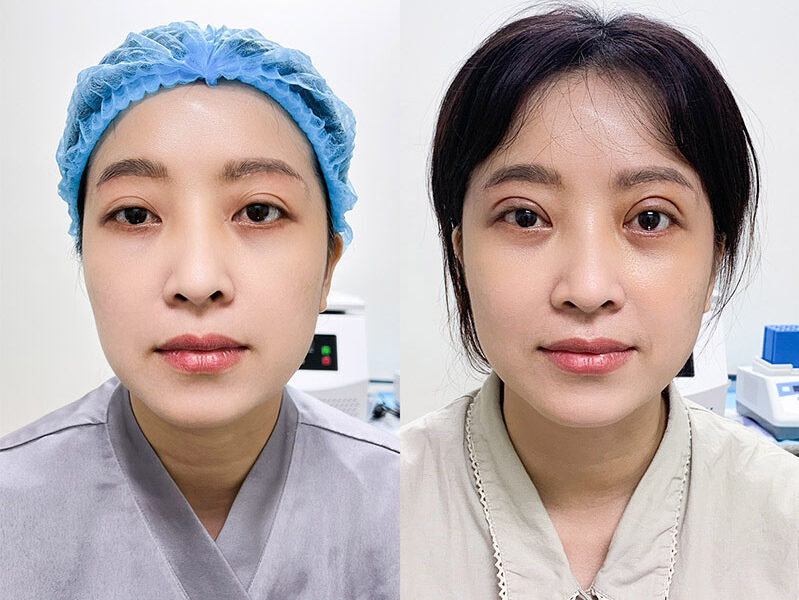 Nguyên nhân cắt mí bị già và cách khắc phục 11 cat mi bi gia 9 e1758633519362