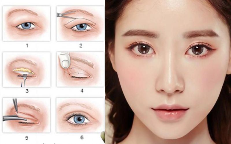 Cắt mí mắt có được vĩnh viễn không?