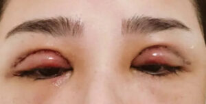 Cắt mí bị hỏng có sửa được không? Bao lâu thì sửa được?