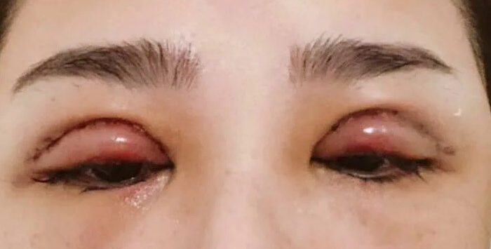 Cắt mí bị hỏng có sửa được không? Bao lâu thì sửa được?