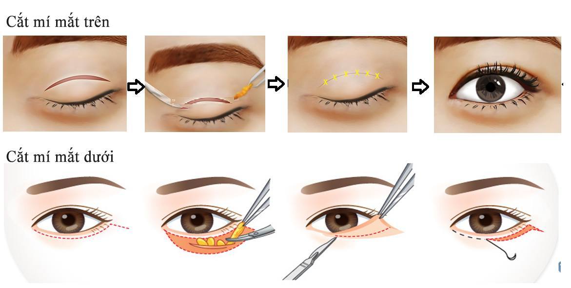 Cắt mí mắt Hàn Quốc 1 cat mi mat 3