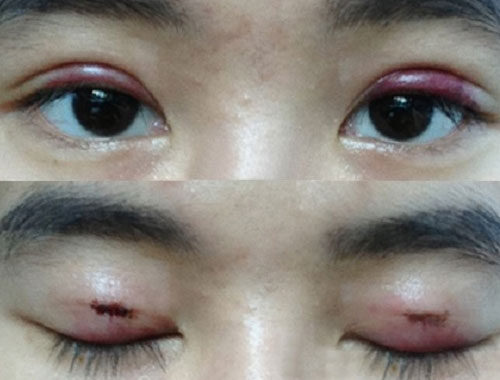 cat mi mat bi hong e1758689301199