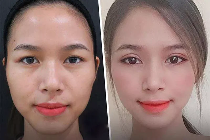 Cắt mí mắt Hàn Quốc 2 cat mi mat han quoc 2 e1758704963701