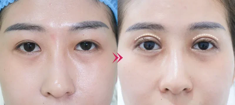 Mắt sụp mí nên cắt mí hay treo chân mày? 7 cat mi mat han quoc 9 e1758705189628