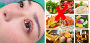 Nhấn mí kiêng ăn gì? Kiêng trong bao lâu?