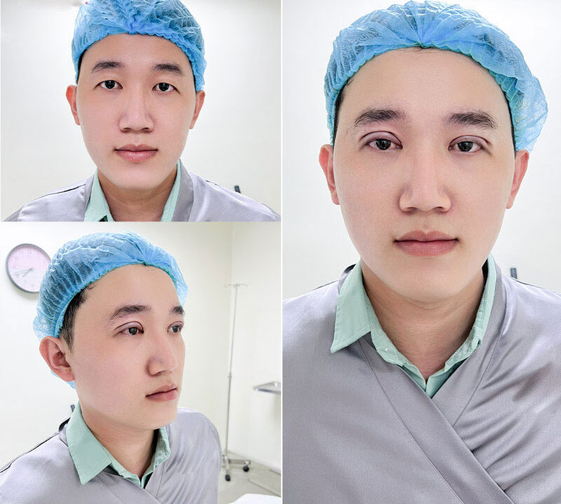 Cắt mí mắt nam có gì khác biệt so với nữ giới? 1 cat mi nam 6 e1757475858693