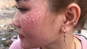 thuốc chấm tàn nhang