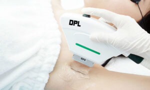 Công nghệ triệt lông DPL