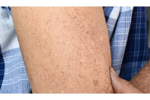 Da chân bị đốm nâu