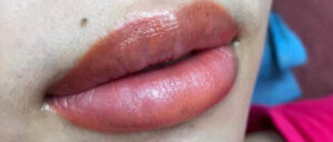 Môi bong mảng sáng mảng tối – nguyên nhân đến từ đâu?