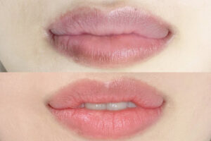 Môi thâm bẩm sinh