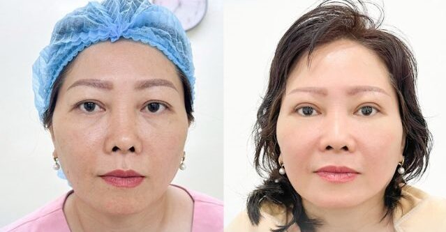 Cắt da thừa mí trên 11 dr eye cat da thua mi tren 11 e1758682476457
