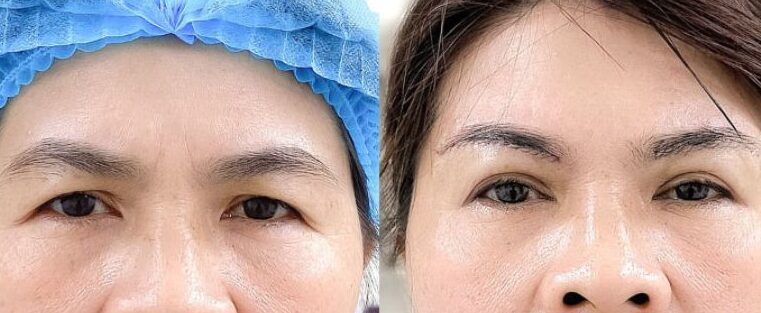 Cắt da thừa mí trên 12 dr eye cat da thua mi tren 12 e1758682527460