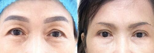 Cắt da thừa mí trên 13 dr eye cat da thua mi tren 13 e1758682585787
