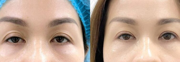 Cắt da thừa mí trên 14 dr eye cat da thua mi tren 14 e1758682692254