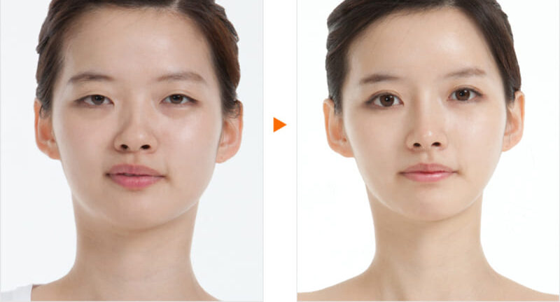 Mở rộng góc mắt trong 4 dr eye cpf mo rong goc mat trong 6 e1758794961353