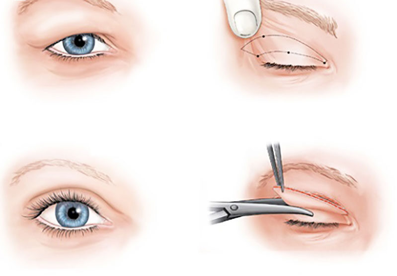 Chỉnh cơ mí mắt 1 dr eye dni lmc chinh co mi mat 1 e1758708066342