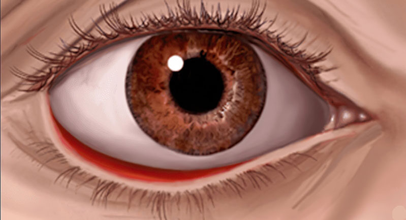Khâu cơ kéo mi dưới để điều trị lật mi dưới 1 dr eye khau co keo mi duoi de dieu tri lat mi duoi 1 e1758708516840