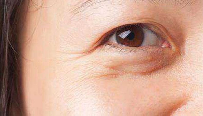 Mắt sụp mí nên cắt mí hay treo chân mày? 2 dr eye lay mo da thua mi tren 1 e1758725189316