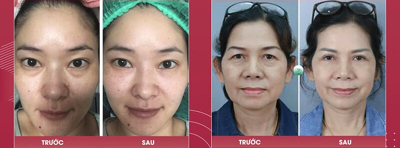 Loại bỏ mỡ bọng mắt 7 dr eye loai bo mo bong mat 10 e1758875245360