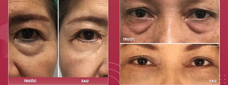 Loại bỏ mỡ bọng mắt 9 dr eye loai bo mo bong mat 11 e1758875357853