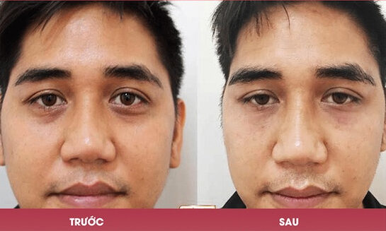 dr eye loai bo mo bong mat 12 e1758875280447