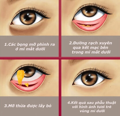 Loại bỏ mỡ bọng mắt 2 dr eye loai bo mo bong mat 2 e1758874596659