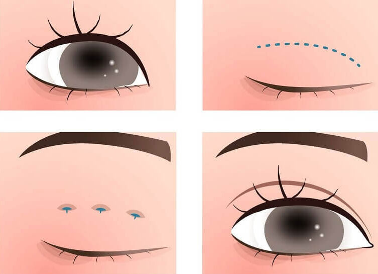 Bấm mí mắt 2 dr eye ni nhan mi 1 e1758701375818